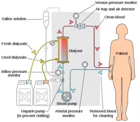 Disposable Sterilized Dialyzer